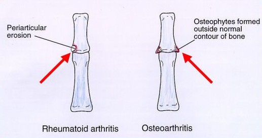 Illustration of Different Types of Arthritis